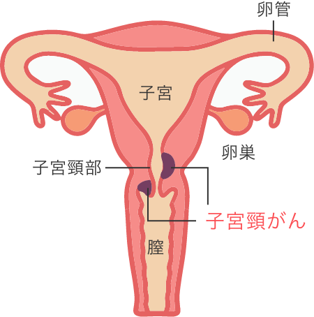 子宮頸がん検診