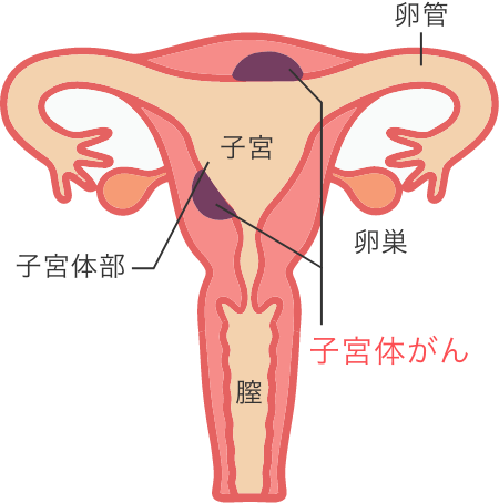 子宮体がん検診